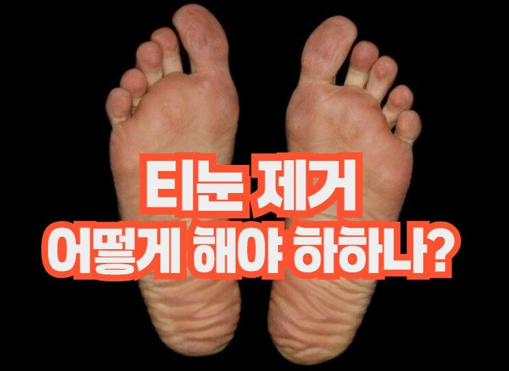 티눈 제거